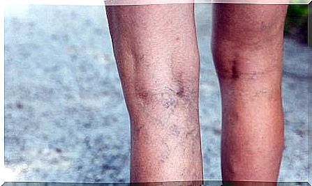 Prevention against varicose veins