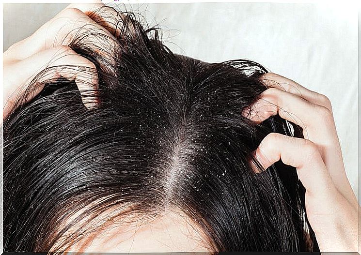 6 effective remedies for head fungus