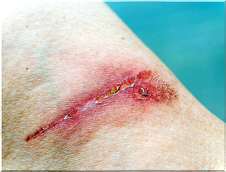 Symptoms of diabetes: poor wound healing