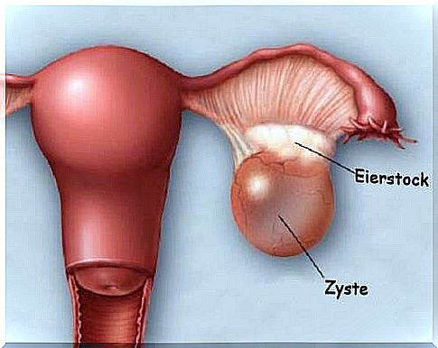 Ovarian cyst - abdominal pain