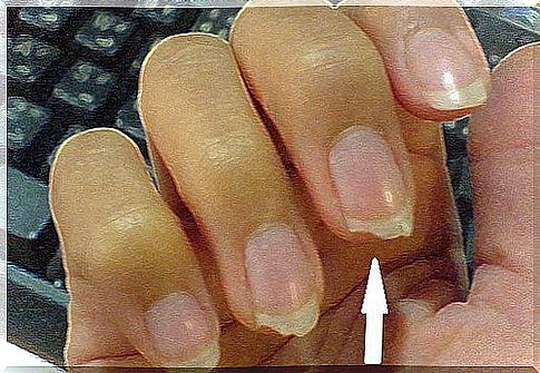 Brittle nails - what can I do?