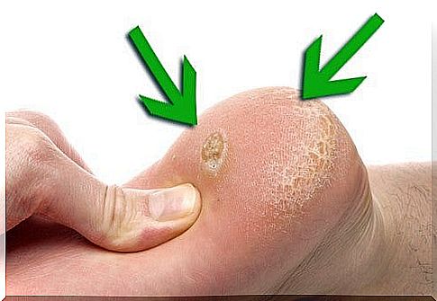 How do you remove calluses on the feet?