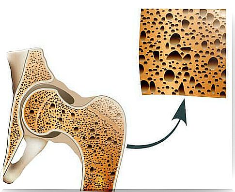 Natural remedies for osteoporosis