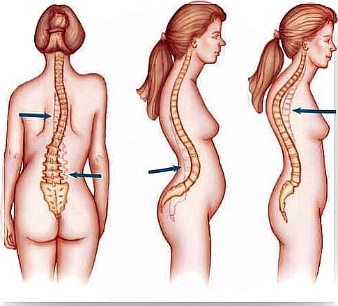 Scoliosis commonly affects women