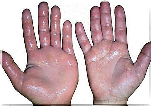 Six home remedies for swollen hands