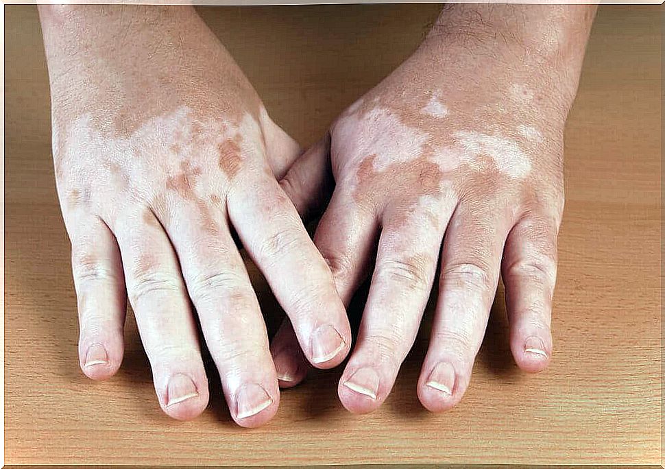 Vitiligo can cause white spots on the skin