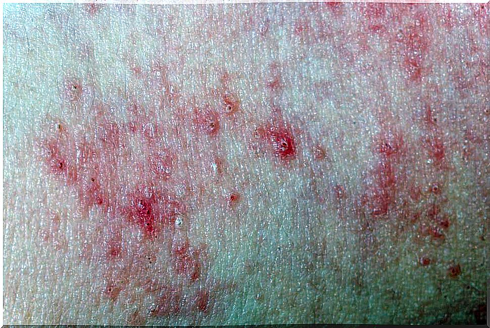 Acne can be a trigger of red patches on the skin