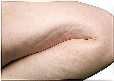 certain foods promote cellulite