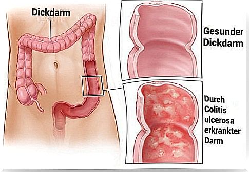 Ulcerative colitis: chronically ill bowel