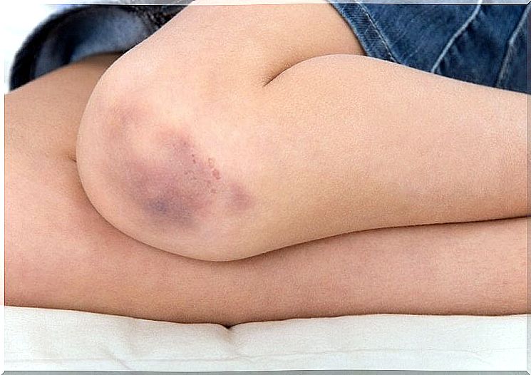 Vaseline as a home remedy for bruises 