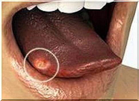 What small ulcers on the tongue reveal about soul and health